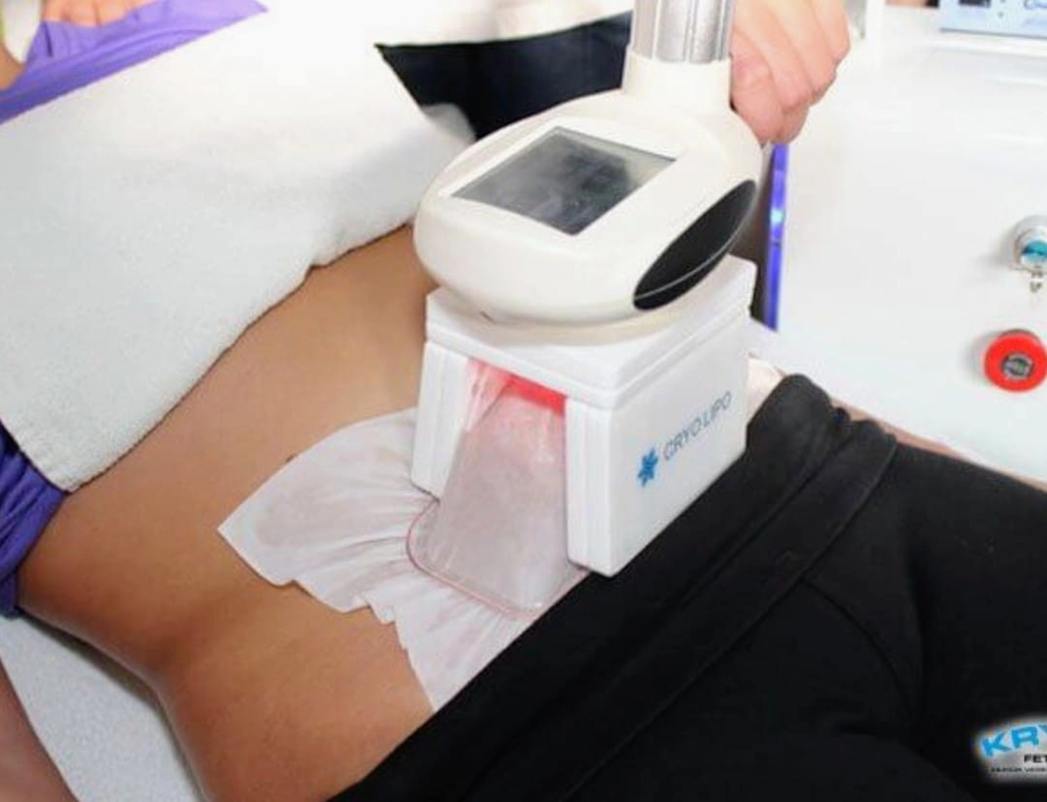 SKYFIT, Frauen bei der Kryolipolyse
